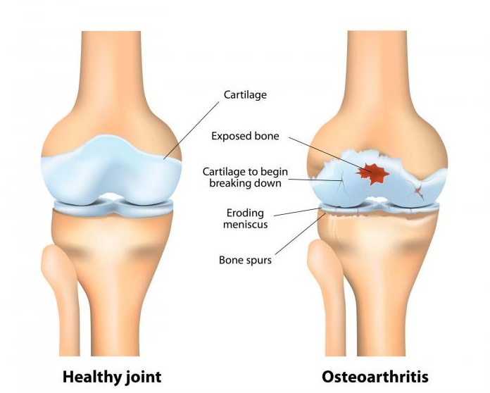 Types Of Arthritis & Tips To Manage Arthritis Symptoms