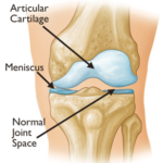 osteo-pic-joint-level1