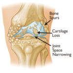 osteo-pic-joint-level3